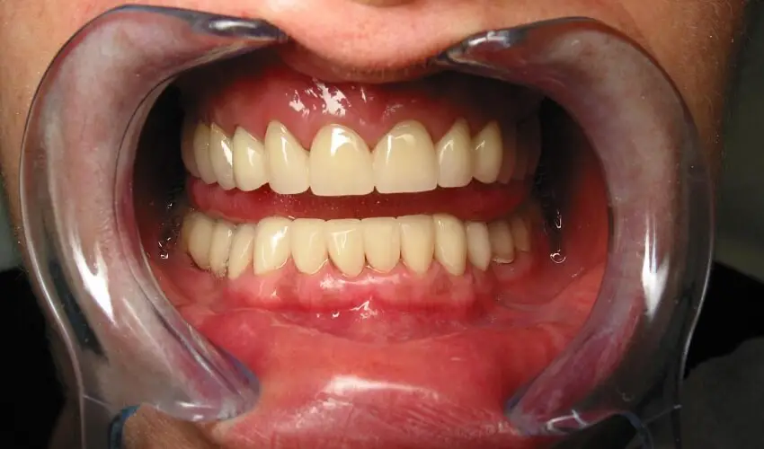 Combien de temps pour shabituer a un bridge dentaire