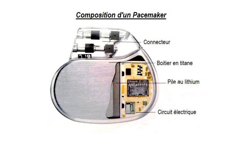 De quoi est compose un pacemaker