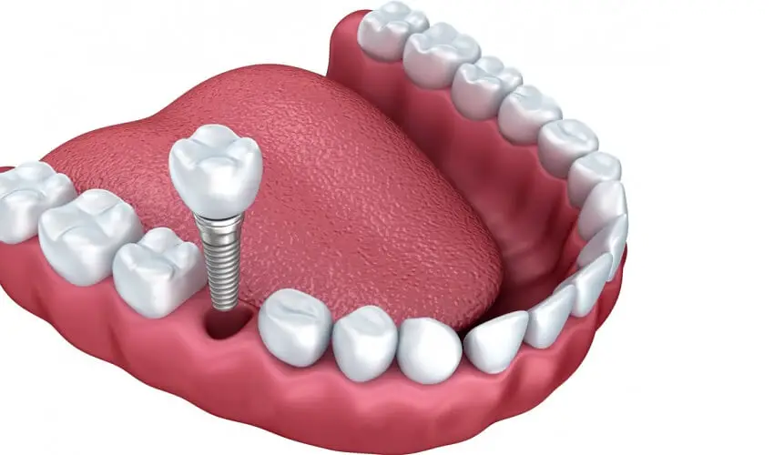 Est ce quun implant dentaire peut tomber