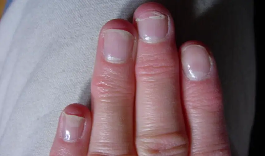 Pourquoi les ongles se dedoublent