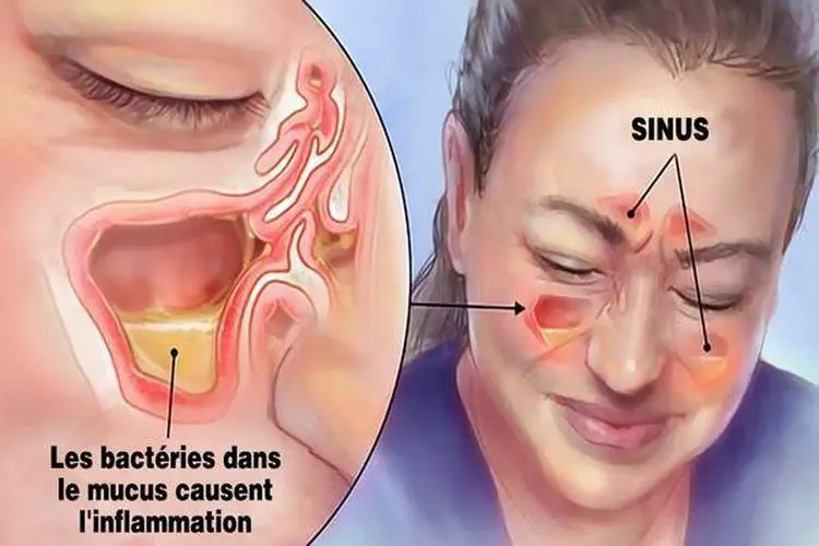 Comment deboucher les sinus
