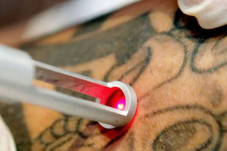 Comment enlever un tatouage