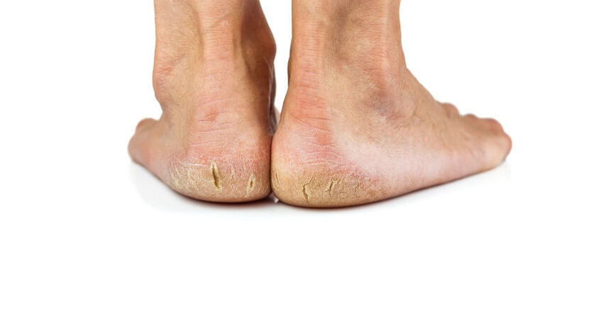 Comment enlever les callosites des pieds